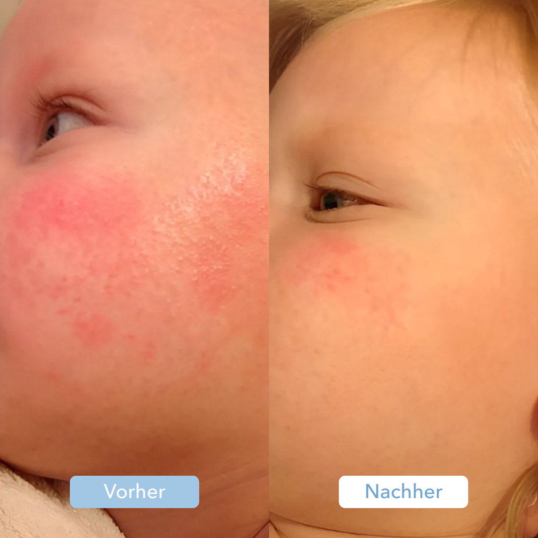 Side-by-side comparison of a child's cheek before and after treatment.