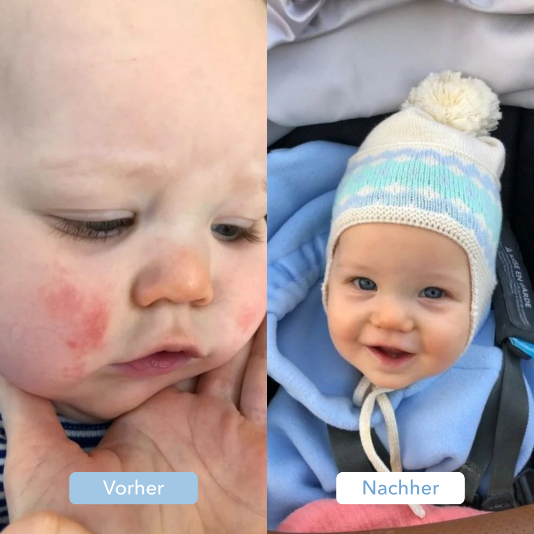 Side-by-side images of a baby before and after, with skin improvement.