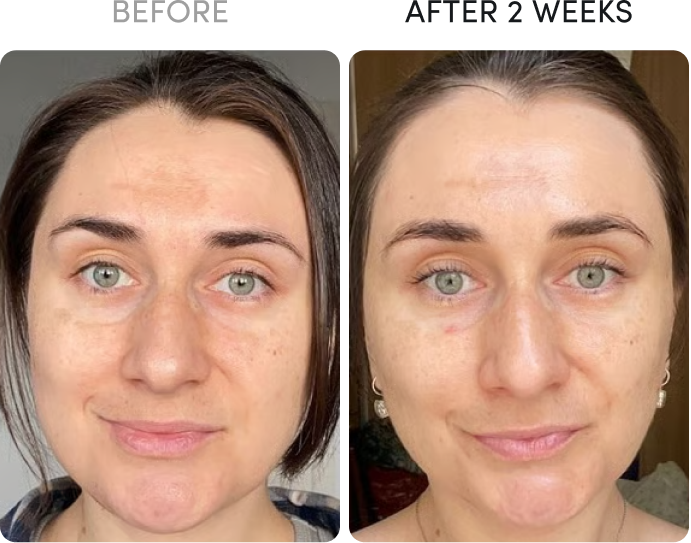 Before and after photos of a woman's face showing improved skin clarity after two weeks.