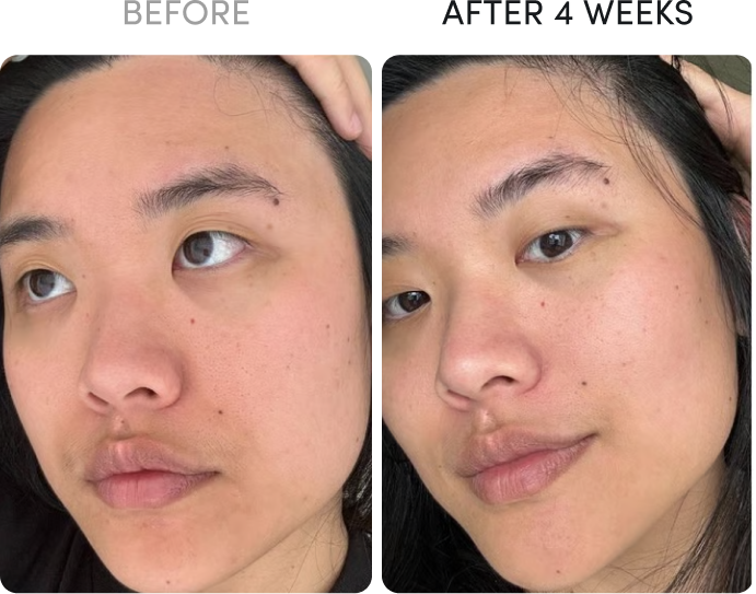 A before and after comparison of a person's face over 4 weeks, showing an improvement in skin clarity.