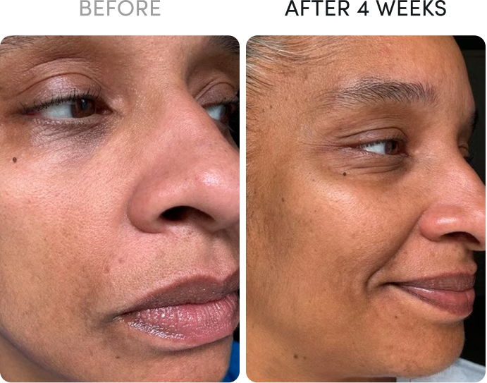 Before and after close-up photos of a woman's face showing skin improvement after four weeks.