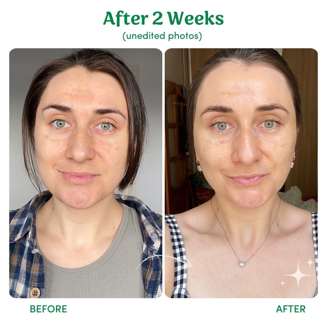 Side-by-side comparison of a person's face before and after two weeks, unedited photos.