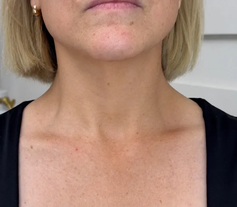 A close-up of a woman's lower face, neck, and chest, showing skin texture and discoloration.