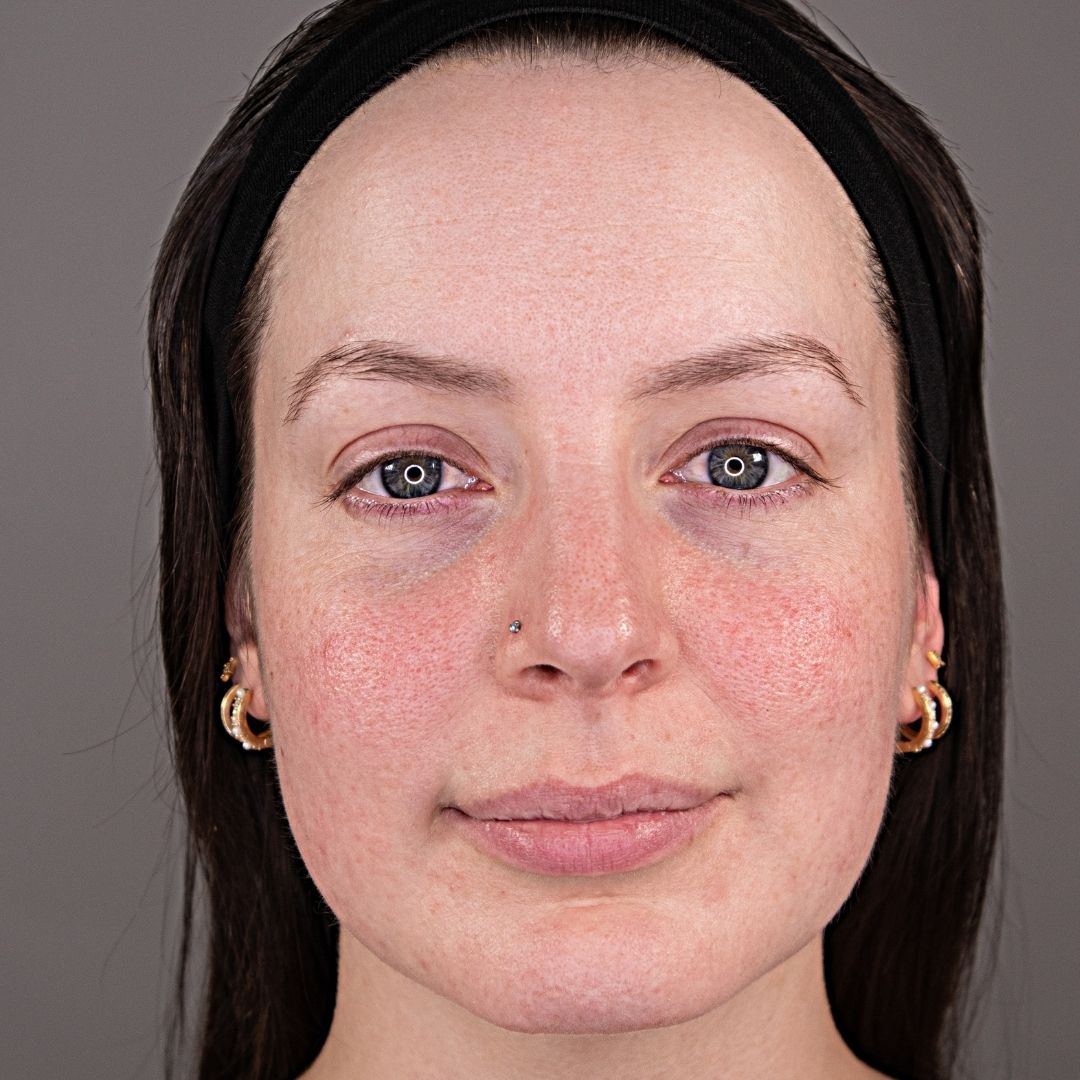 A close-up of a woman's face showing skin redness on her cheeks, a nose stud, and earrings.