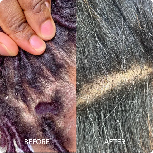 A before-and-after split image showing a close-up of a scalp with flakes and dandruff, then a clean scalp.