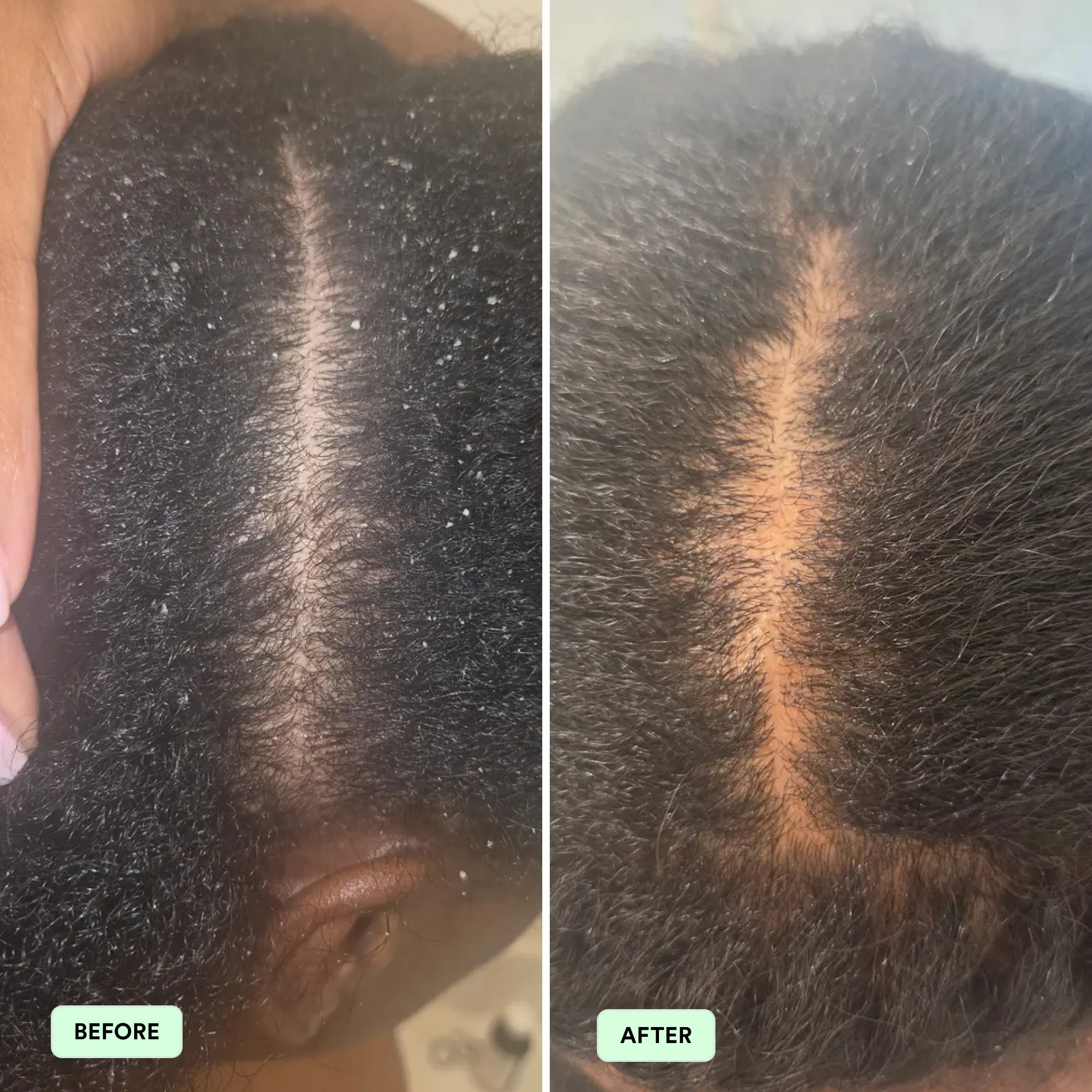 A before and after comparison of a scalp with dandruff, showing the scalp is clean in the after image.