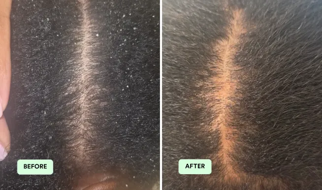 A before and after image showing a scalp with dandruff flakes, and then a clean, flake-free scalp.