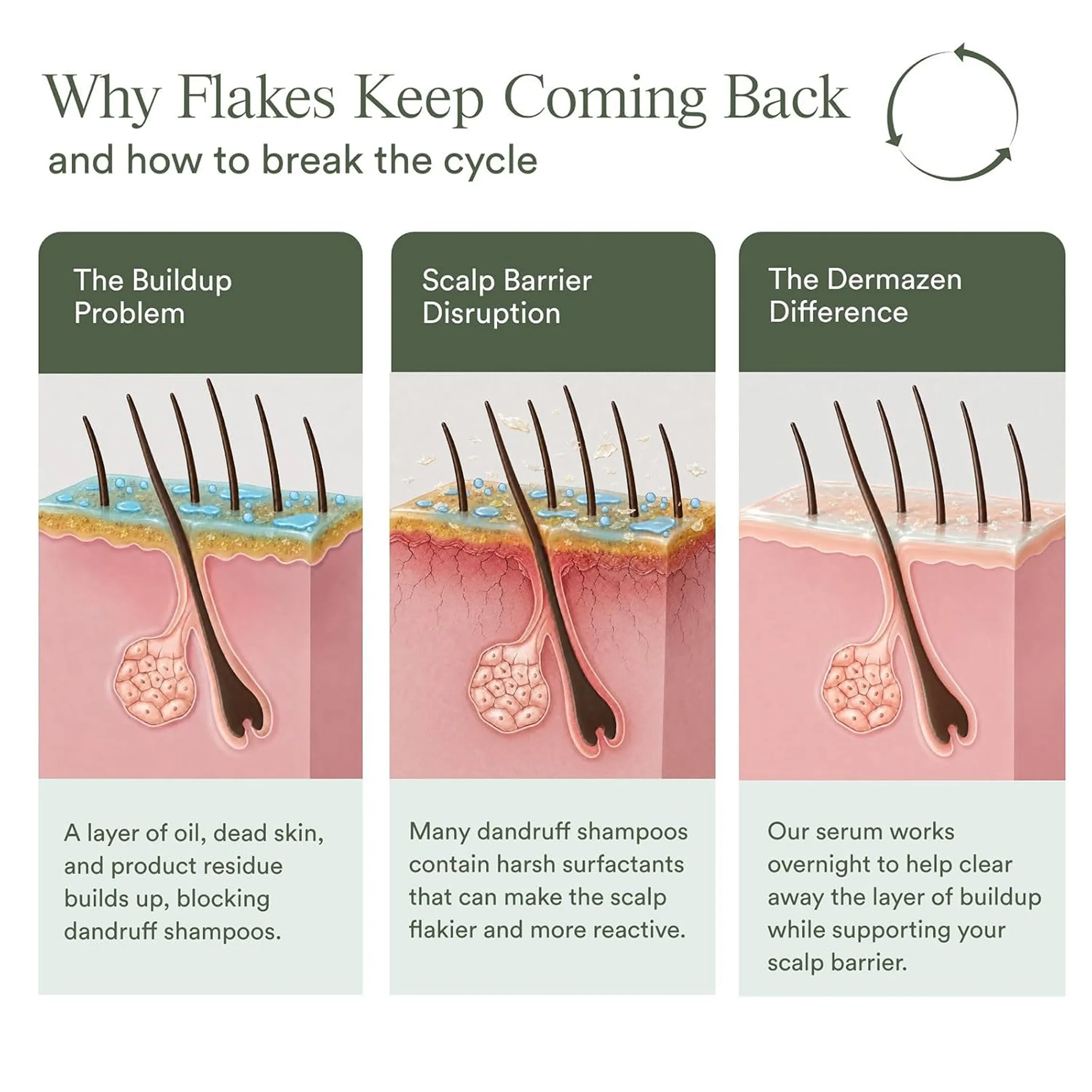 An infographic with three panels illustrating the causes of scalp flakes and a solution for a healthy scalp.