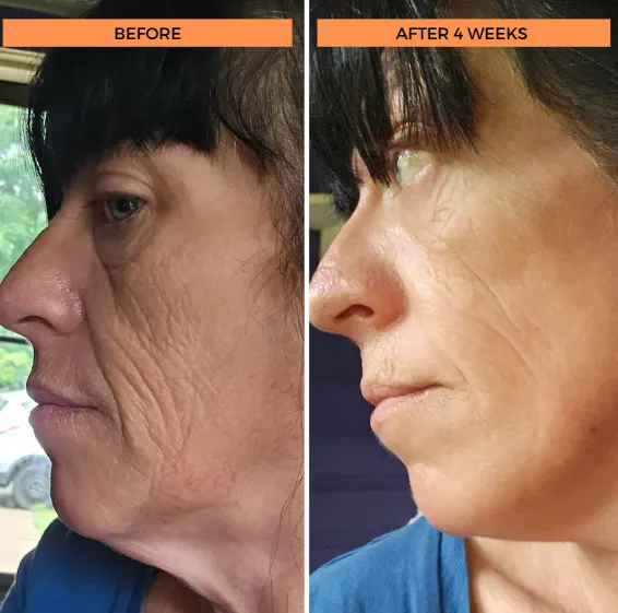 A before and after comparison of a woman's face, showing a reduction in wrinkles after four weeks.