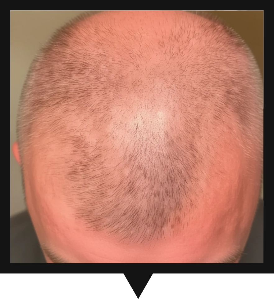 Top view of a person's balding head with short hair.