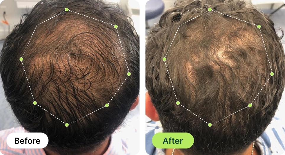 Before and after comparison of hair growth on the top of a person's head.