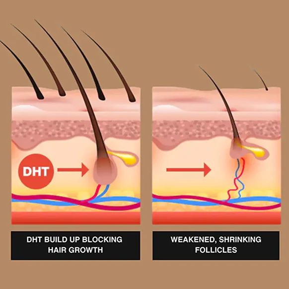 Diagram showing DHT buildup blocking hair growth and weakened, shrinking follicles.
