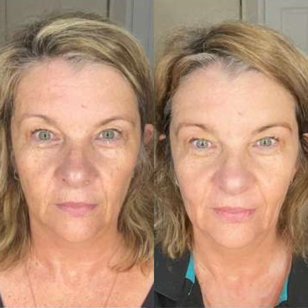 Side-by-side comparison of a woman's face before and after treatment.