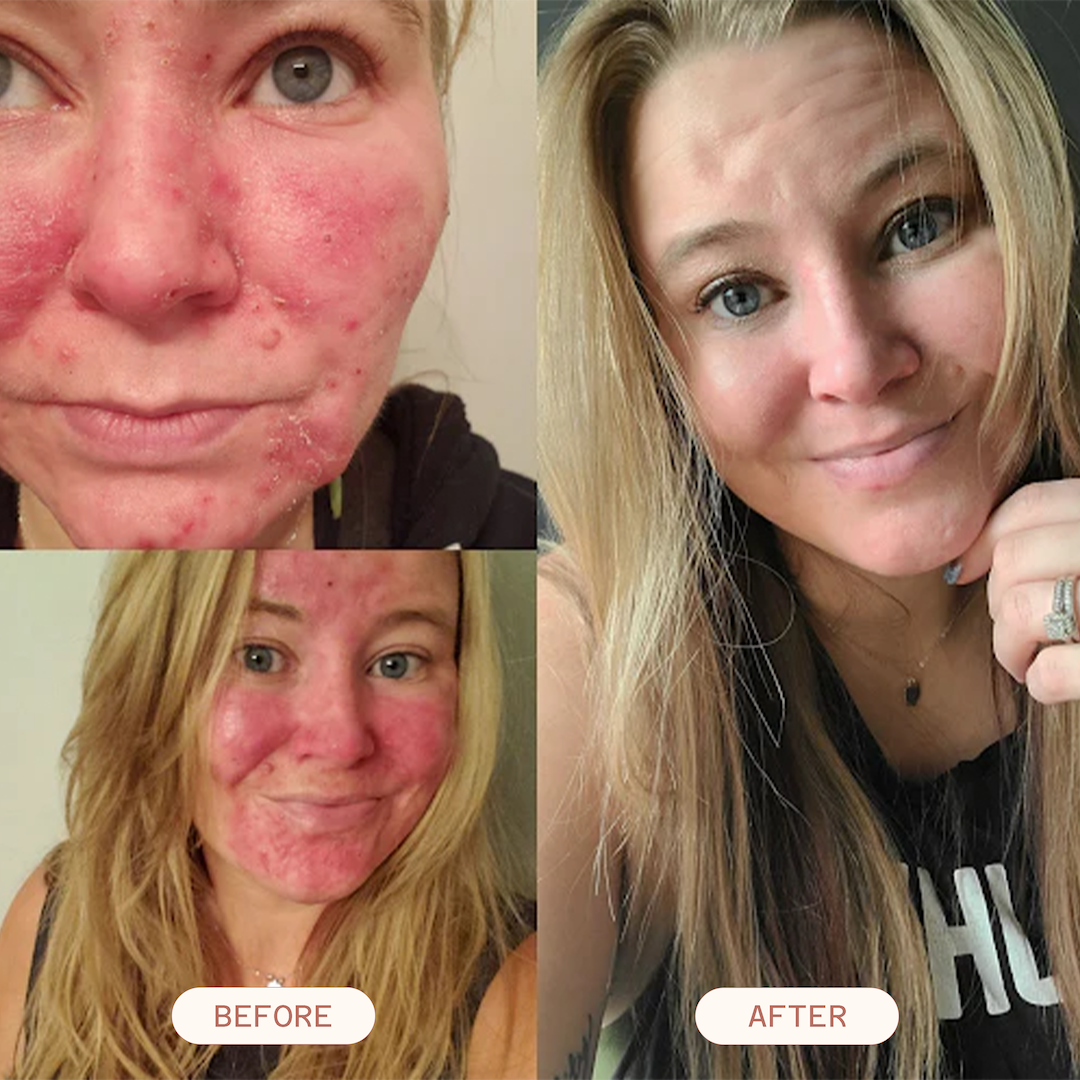 A before-and-after comparison showing a woman's facial skin condition improving from red and inflamed to much clearer.