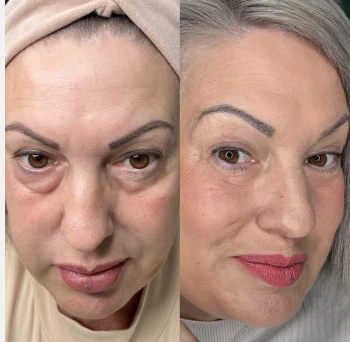 A side-by-side comparison of a woman's face, showing a reduction in under-eye bags and puffiness.