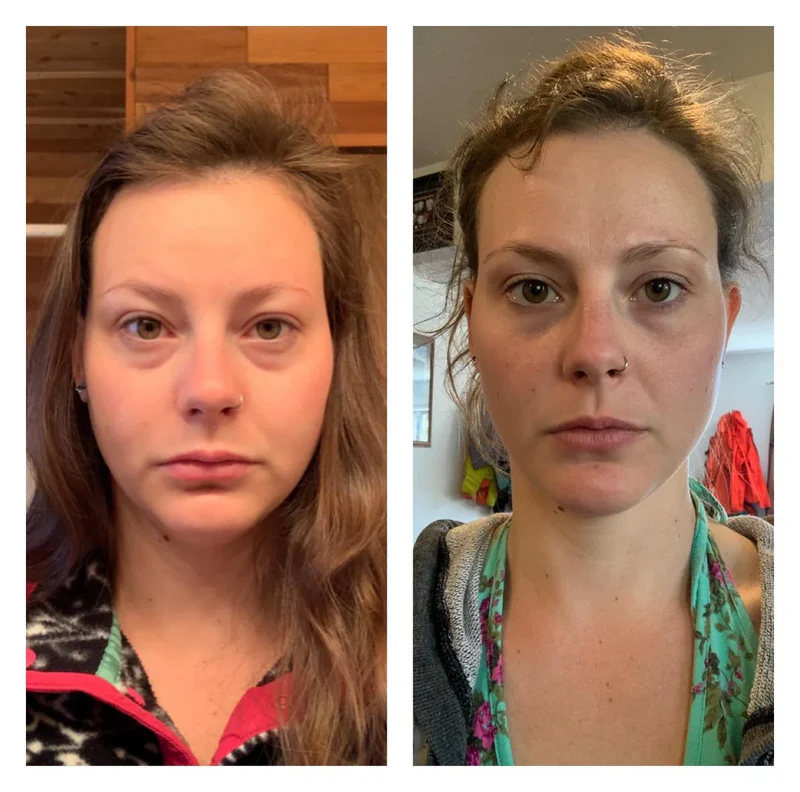 A side-by-side comparison of a woman's face, showing a reduction in under-eye puffiness and dark circles.