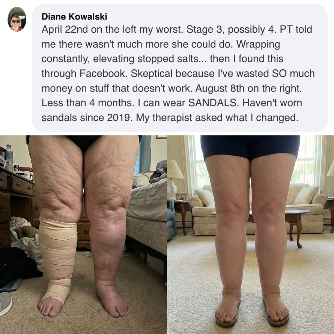 A before and after photo showing a significant reduction in swelling in a woman's legs.