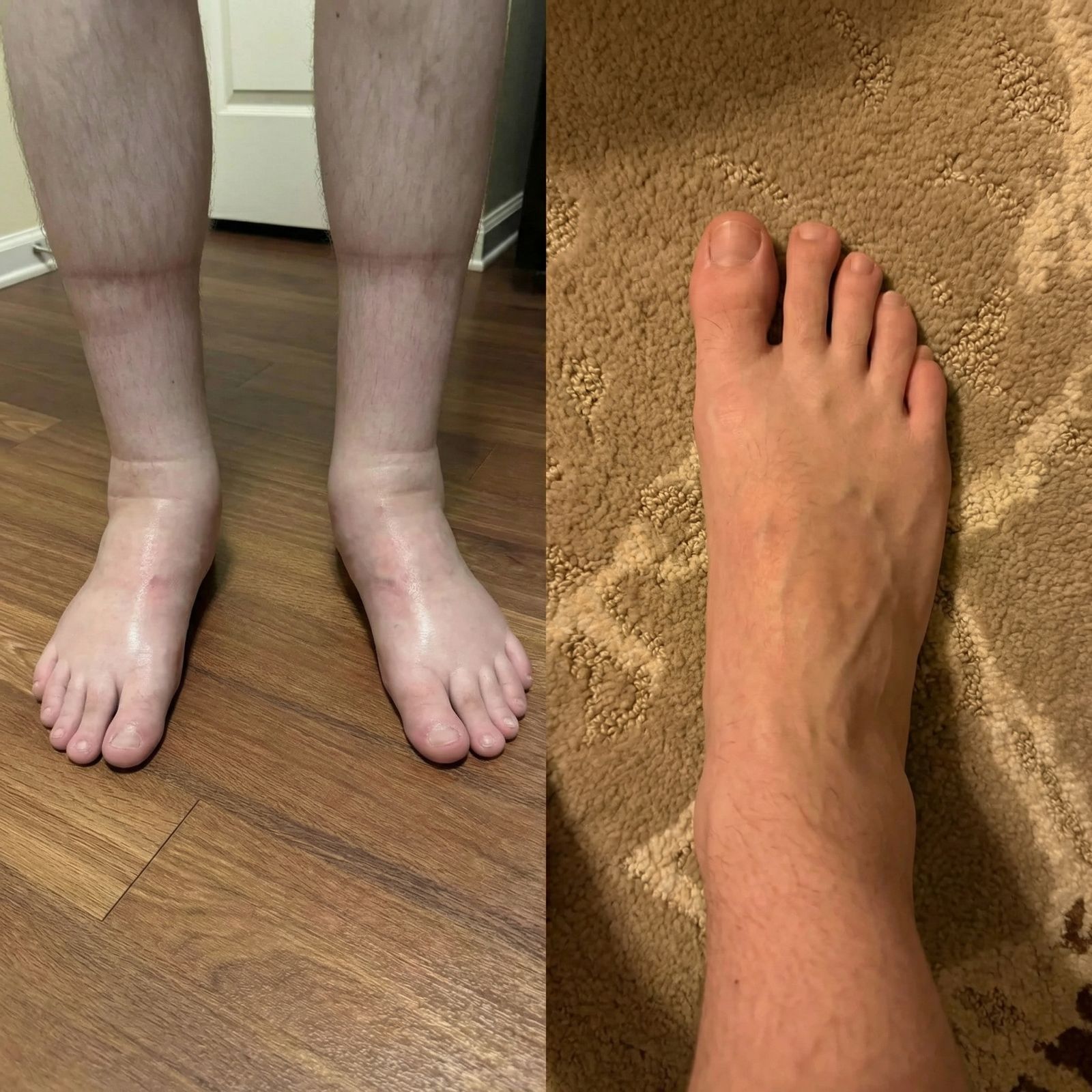 A before-and-after image comparing swollen legs and feet on the left to a non-swollen foot on the right.