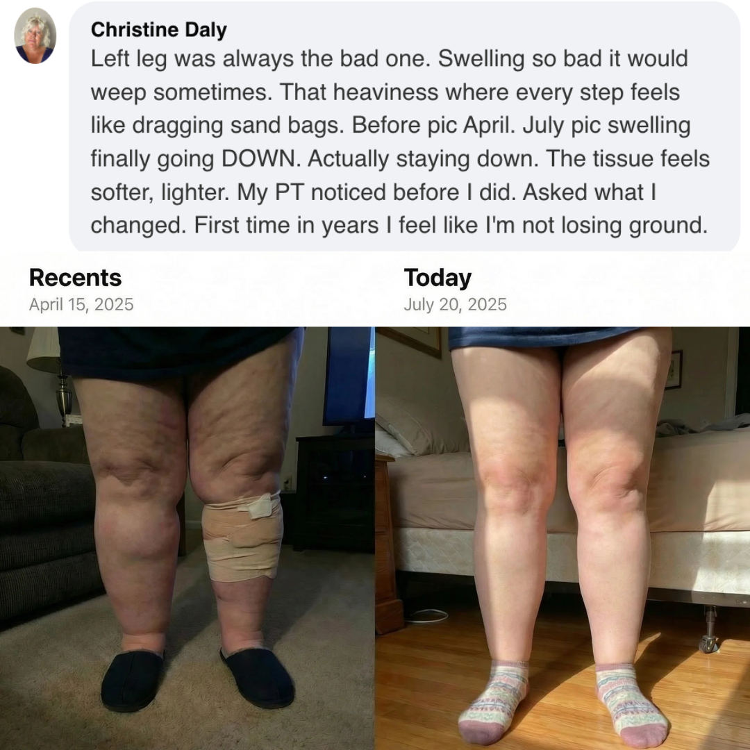 A before-and-after image showing a significant reduction of swelling in a person's legs.