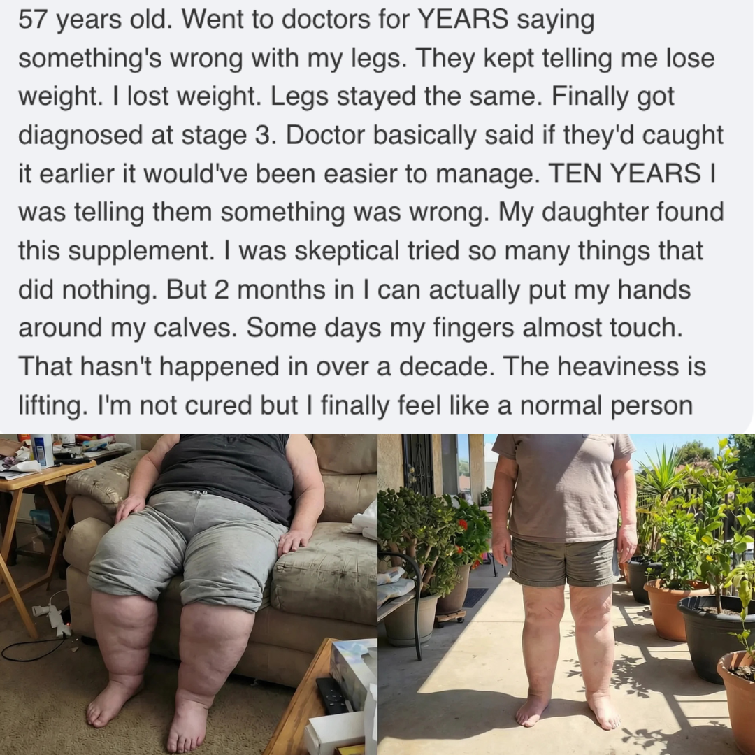 A before-and-after photo showing a person's legs with a significant reduction in swelling.