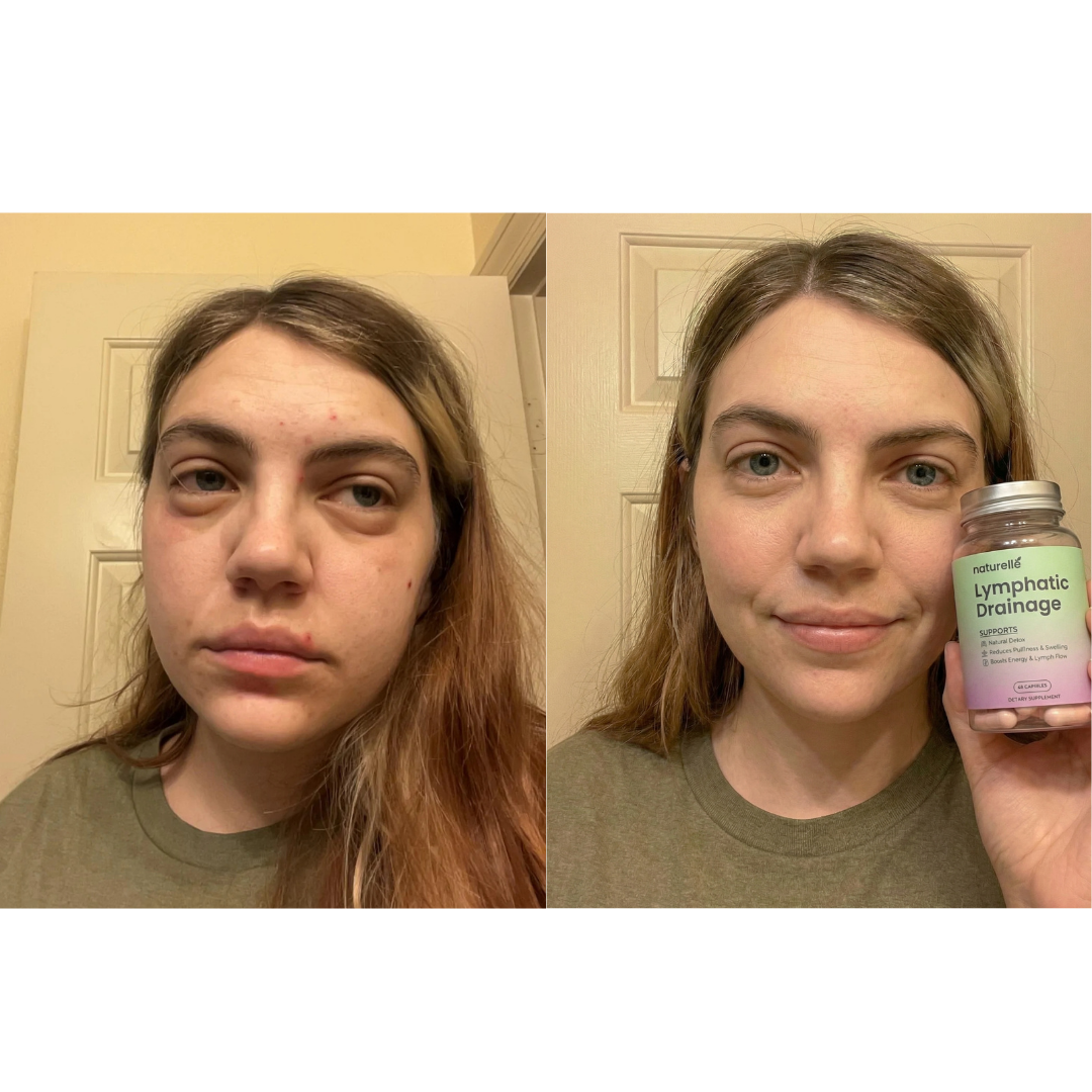 A before and after split image of a woman showing a reduction in facial puffiness while holding a supplement bottle.