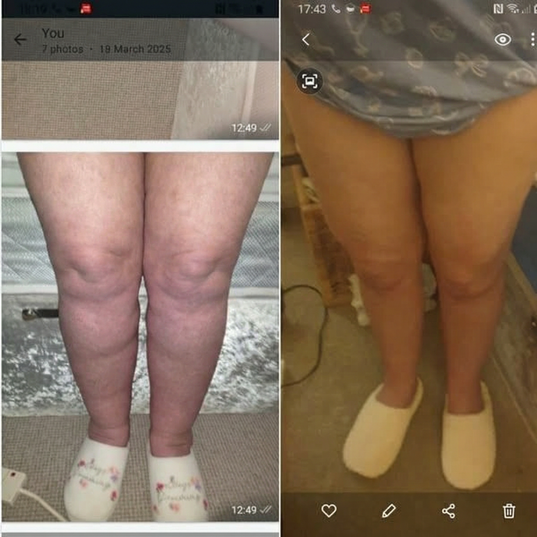 A side-by-side before and after comparison of a person's legs from the thighs down.