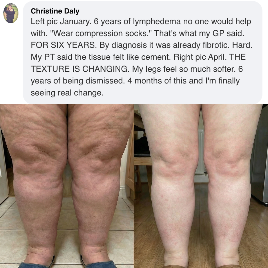 Before and after photos showing a person's legs with a visible reduction in swelling and smoother skin texture.