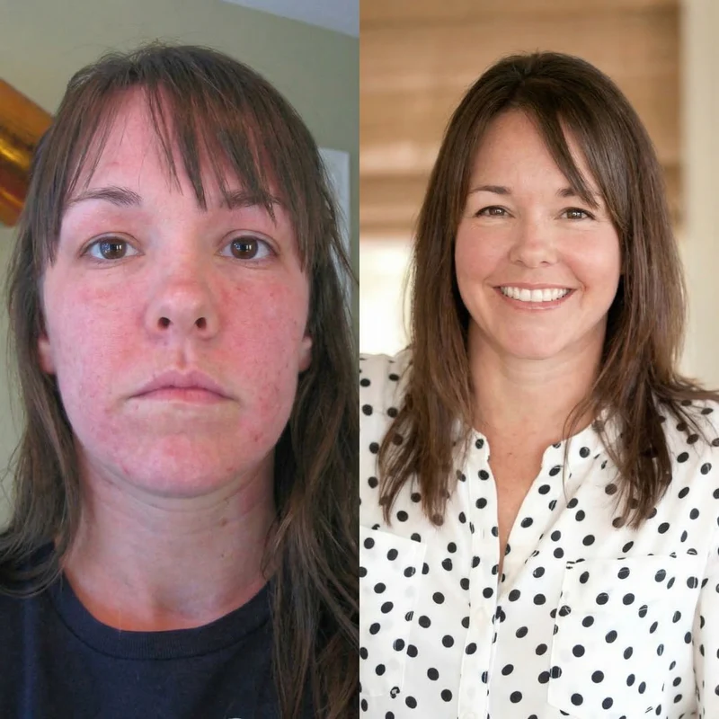 A before and after image showing a woman's face with severe acne and redness, then with clear skin.