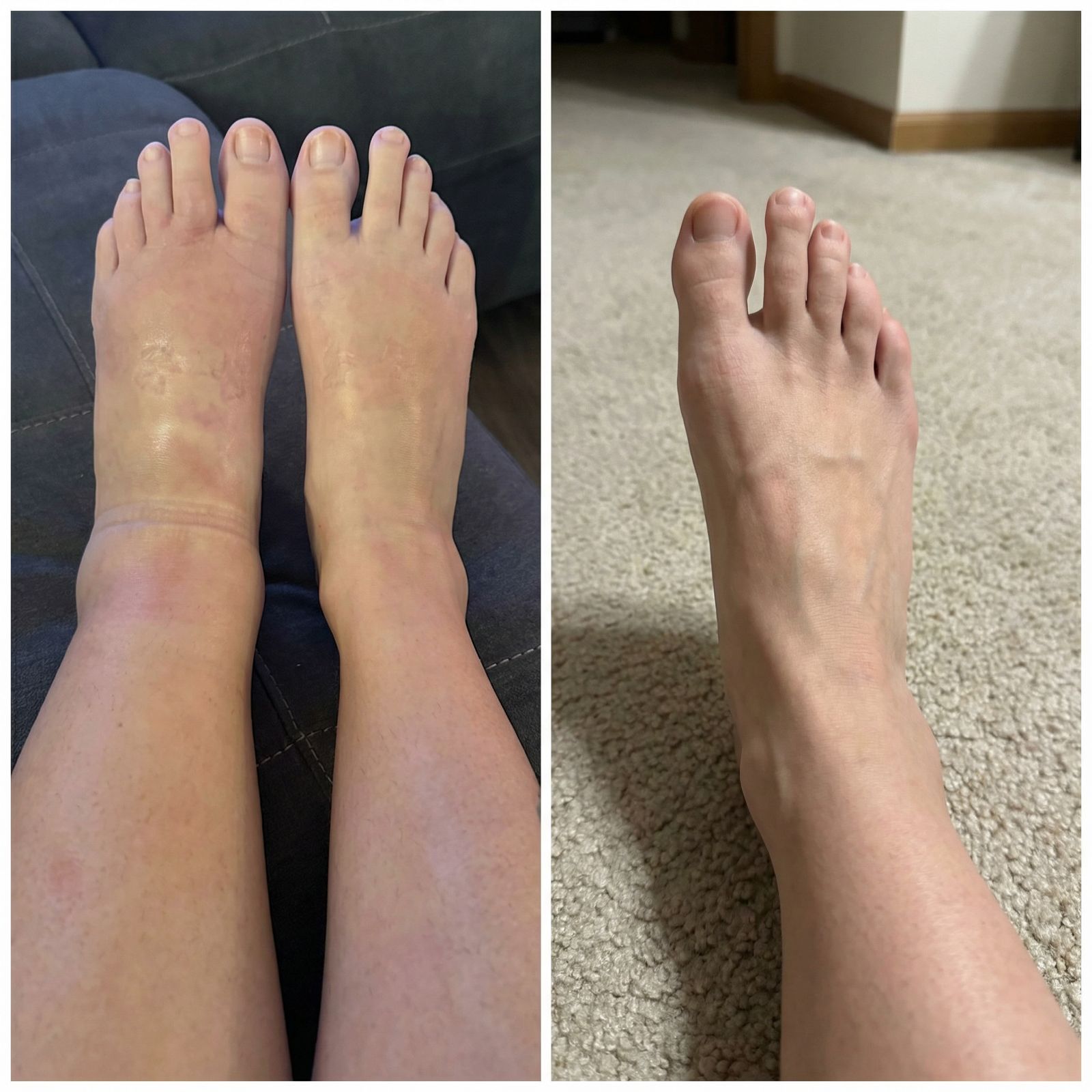A side-by-side comparison showing two swollen feet on the left and one less swollen foot on the right.