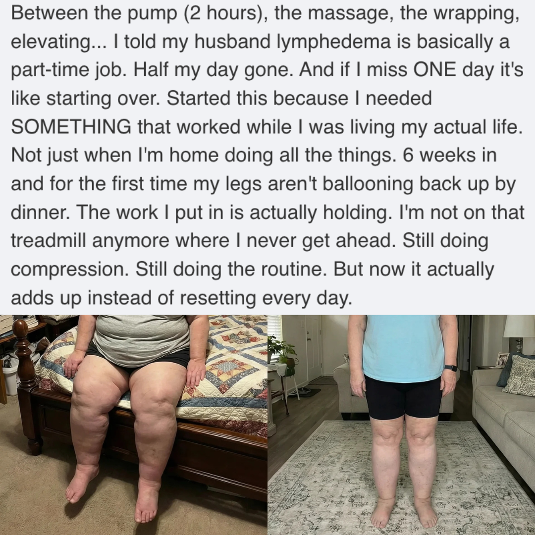 Before and after photos of a woman's legs, showing a significant reduction in swelling.