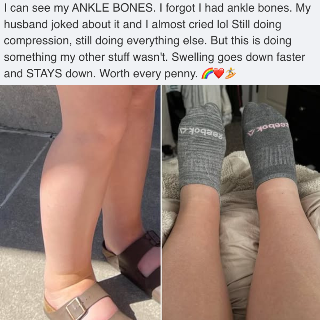 A before-and-after comparison showing a reduction in swelling in a person's ankles and lower legs.