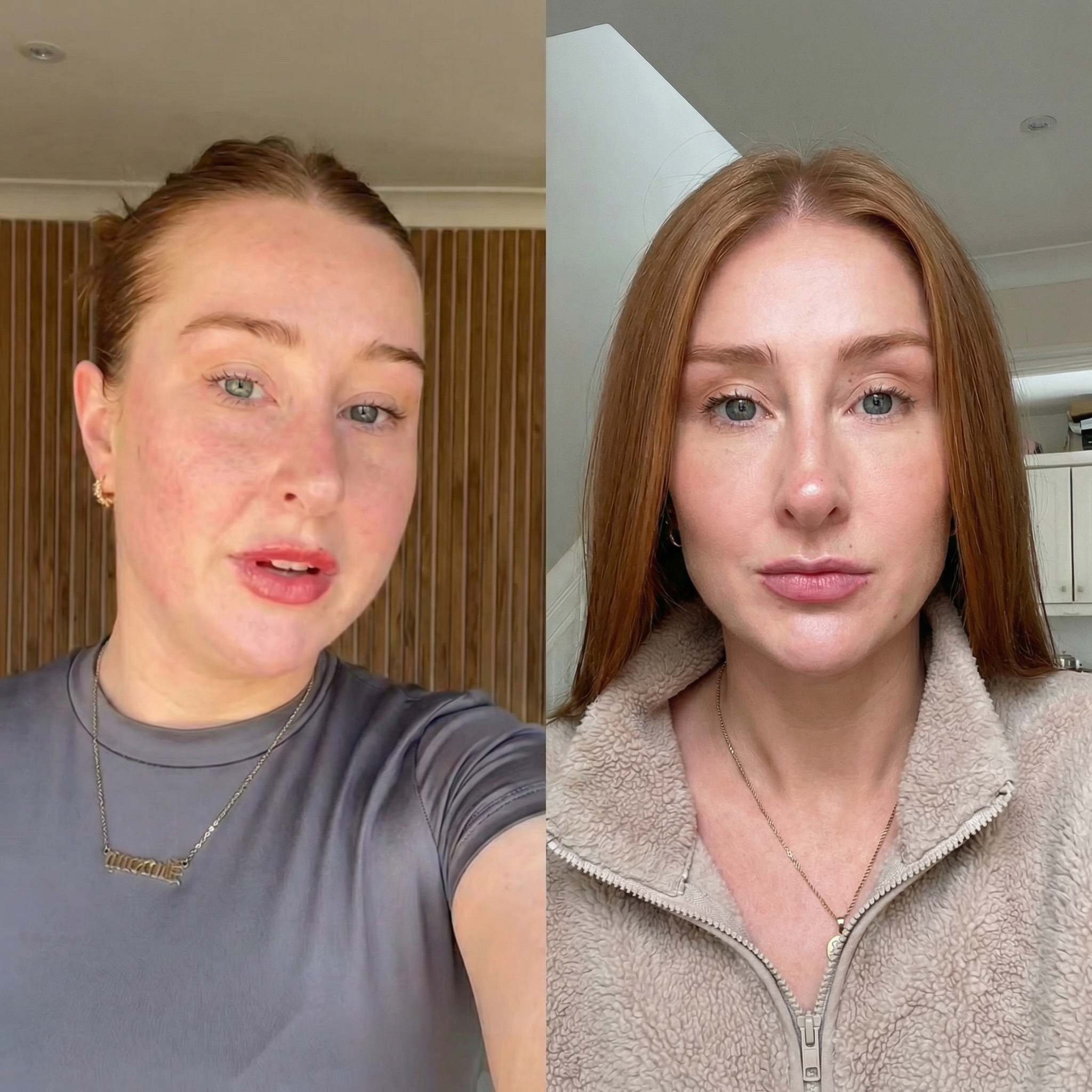 A side-by-side before-and-after image of a woman showing a reduction in skin redness and blemishes.