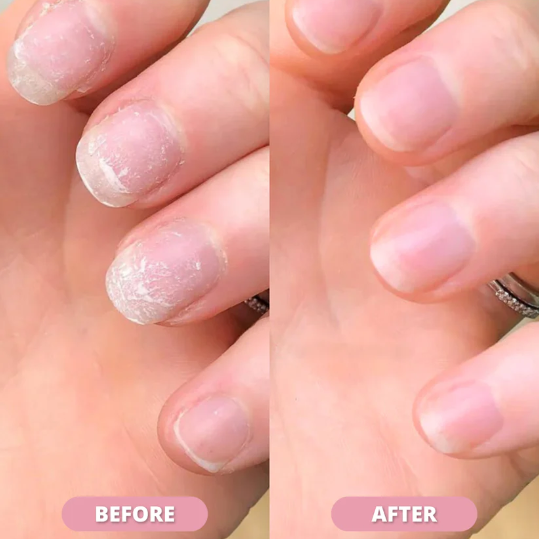 Comparison of fingernails before and after treatment.