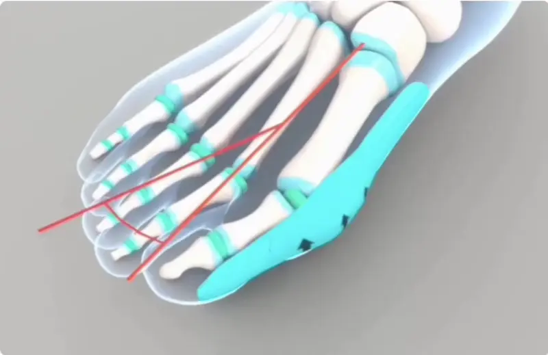 3D illustration of a foot skeleton showing bones and ligaments in blue and red.