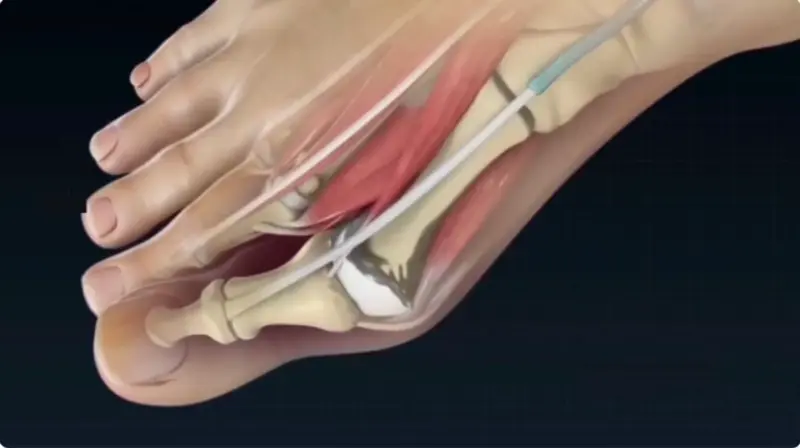 Anatomical diagram of a human foot showing bones, muscles, and tendons.