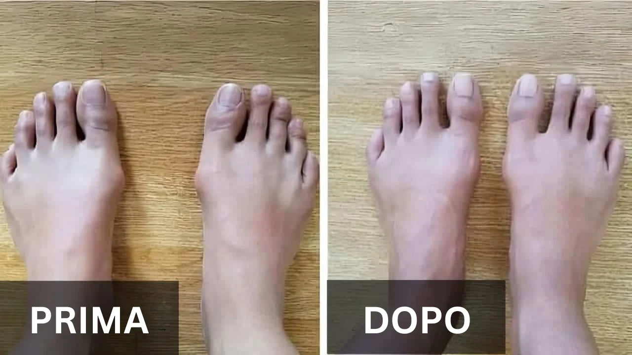 Comparison of two pairs of feet labeled 'Prima' and 'Dopo' on a wooden surface.