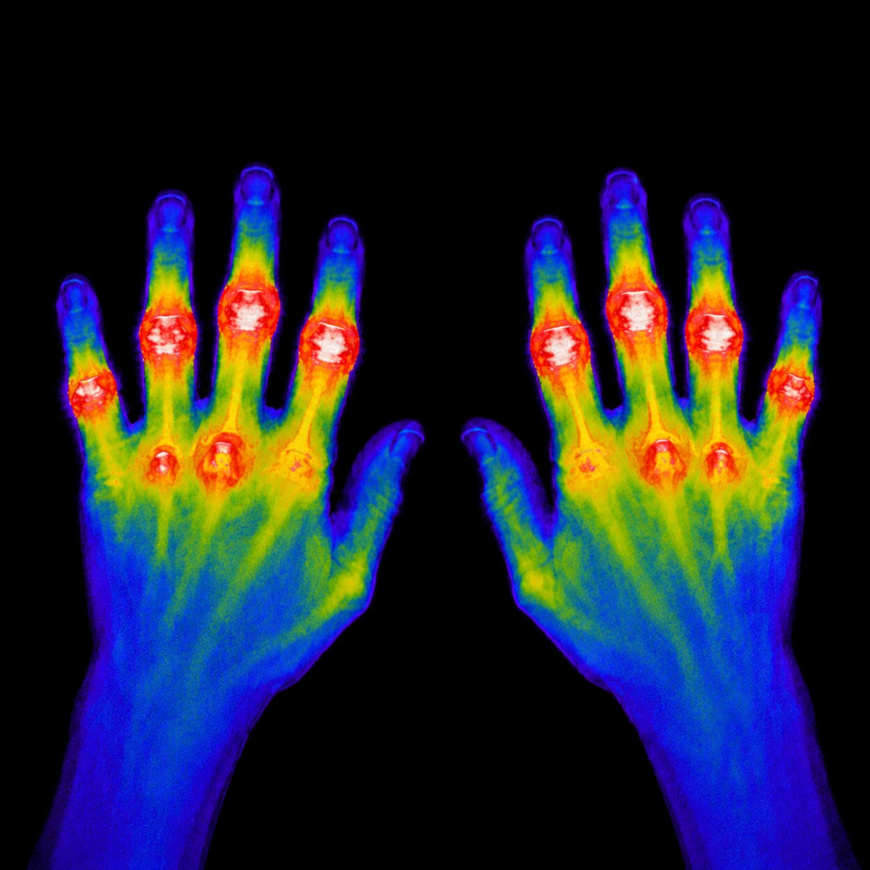 A thermogram of two hands showing inflammation in the knuckles and finger joints.