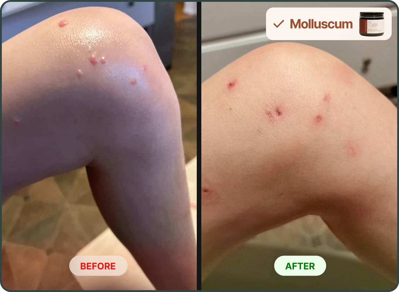 A before-and-after photo showing a skin condition on a knee, with raised bumps on the left and healing spots on the right.