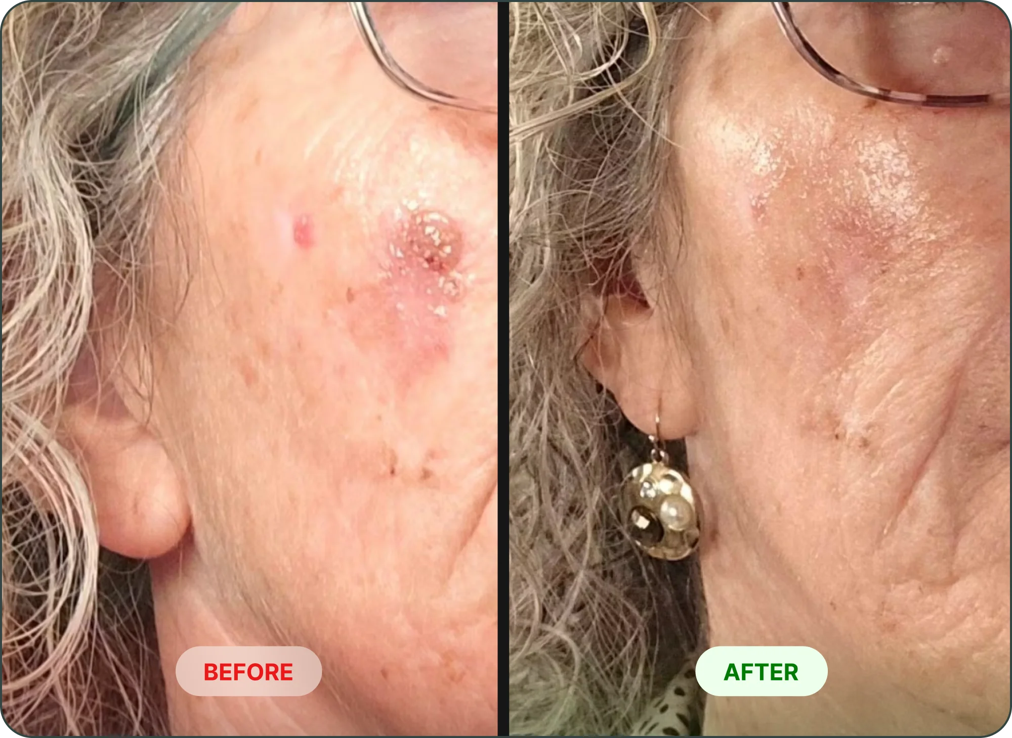A before and after image showing a skin lesion on a woman's cheek that has healed and cleared.