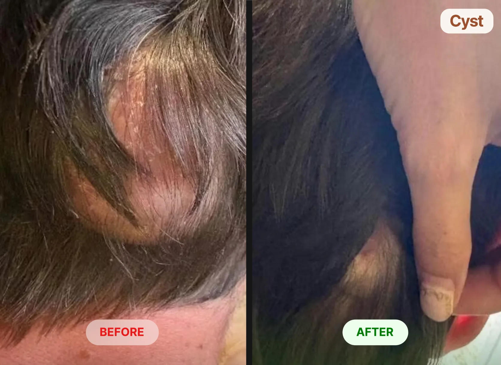 A before and after image showing the reduction of a cyst on a person's scalp.