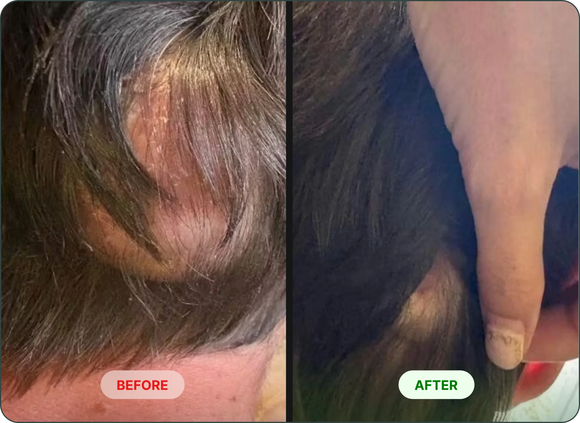 A before and after image showing a flaky, irritated scalp on the left and a clear scalp on the right.