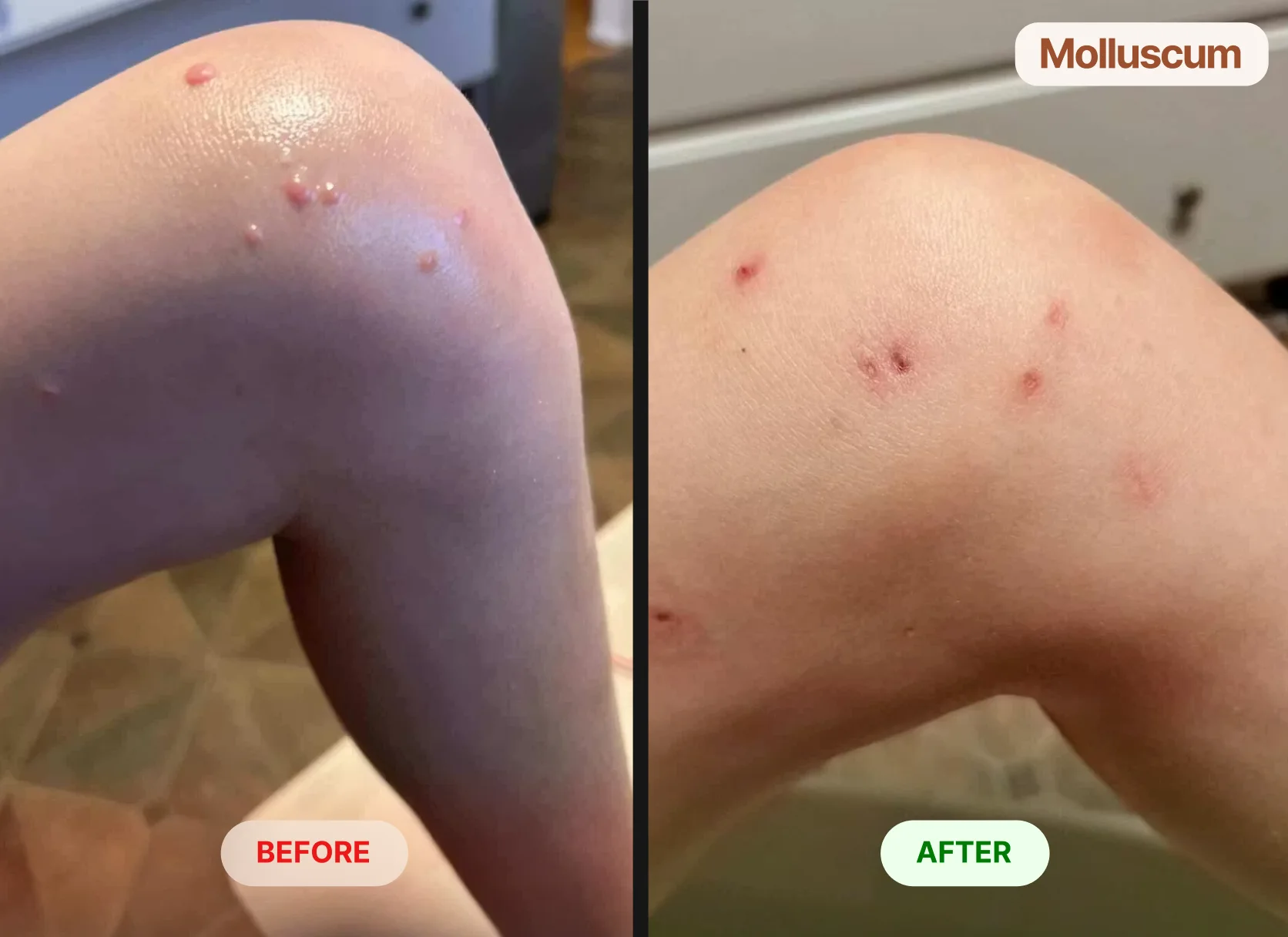 A before-and-after comparison showing molluscum bumps on a knee that have healed into small spots.