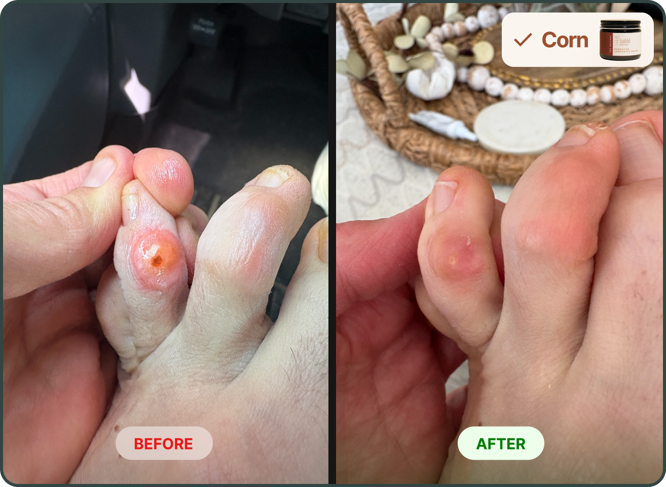 A before and after comparison of a corn on a toe, showing significant healing in the after image.
