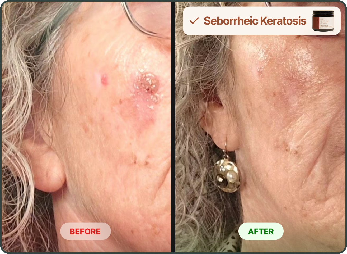 Before and after close-up photos of a woman's cheek showing improvement in a seborrheic keratosis lesion.