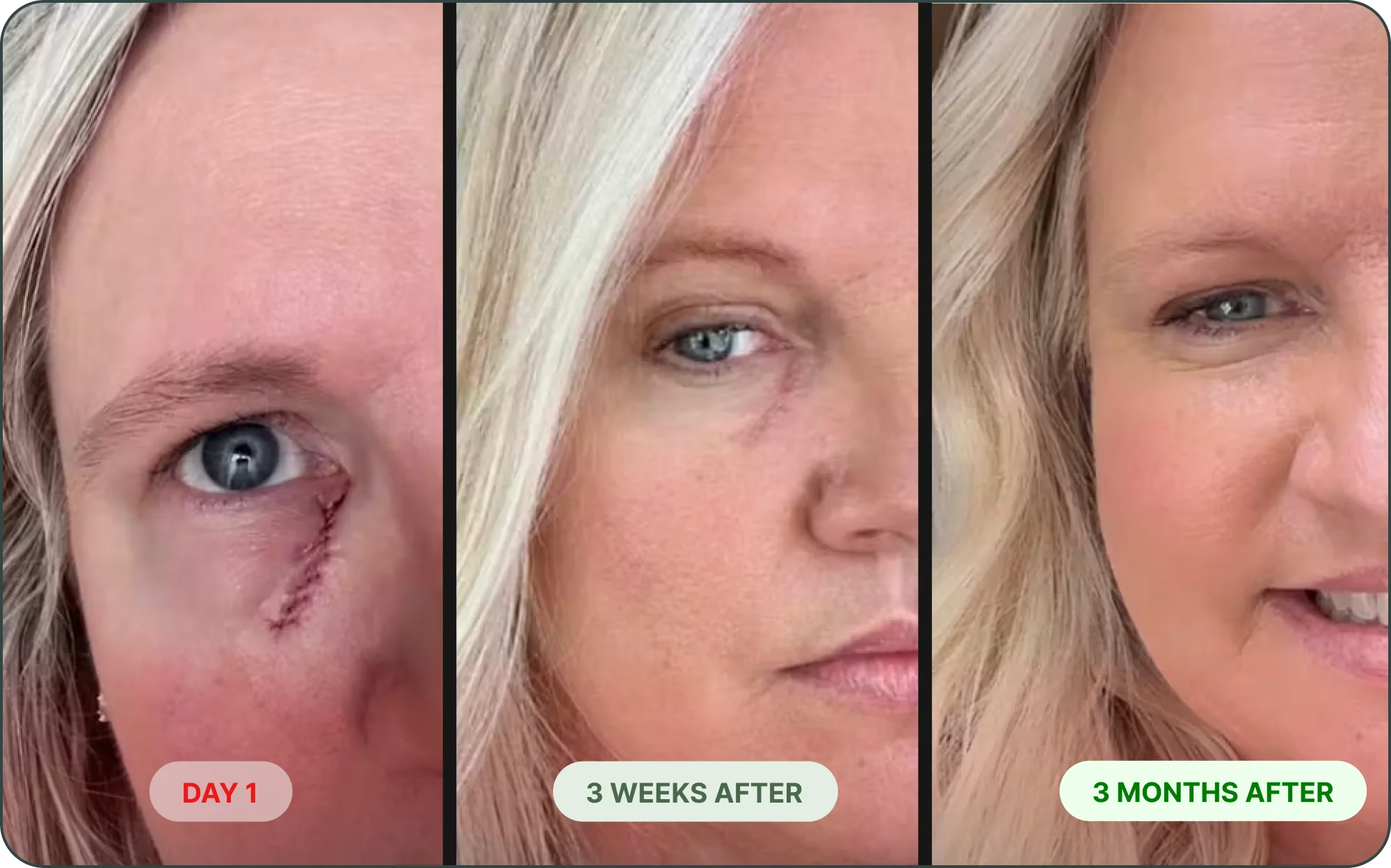 A three-panel image showing the healing progression of a woman's scar under her eye over three months.