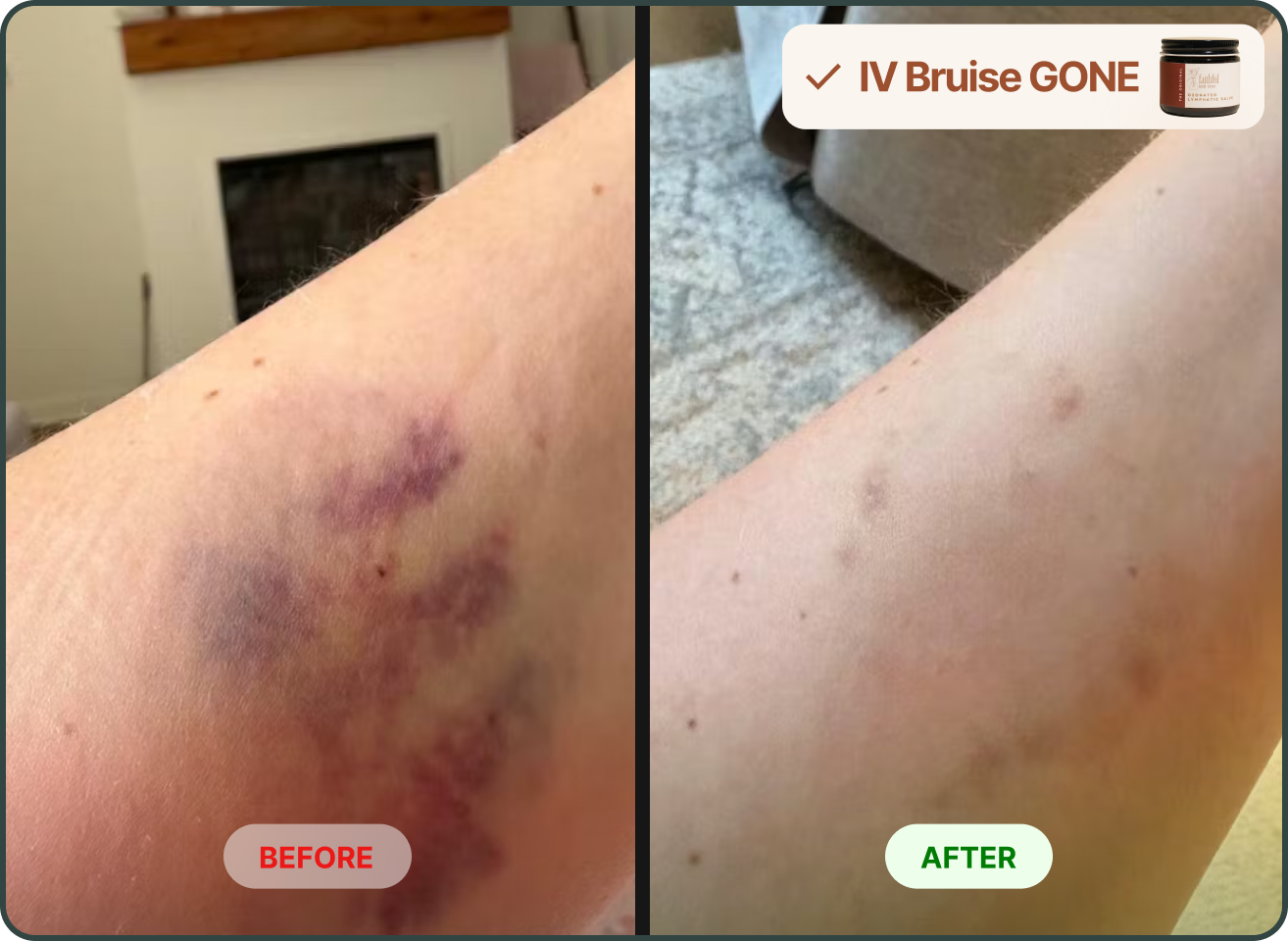 A before and after comparison showing a large bruise on an arm that has significantly faded.