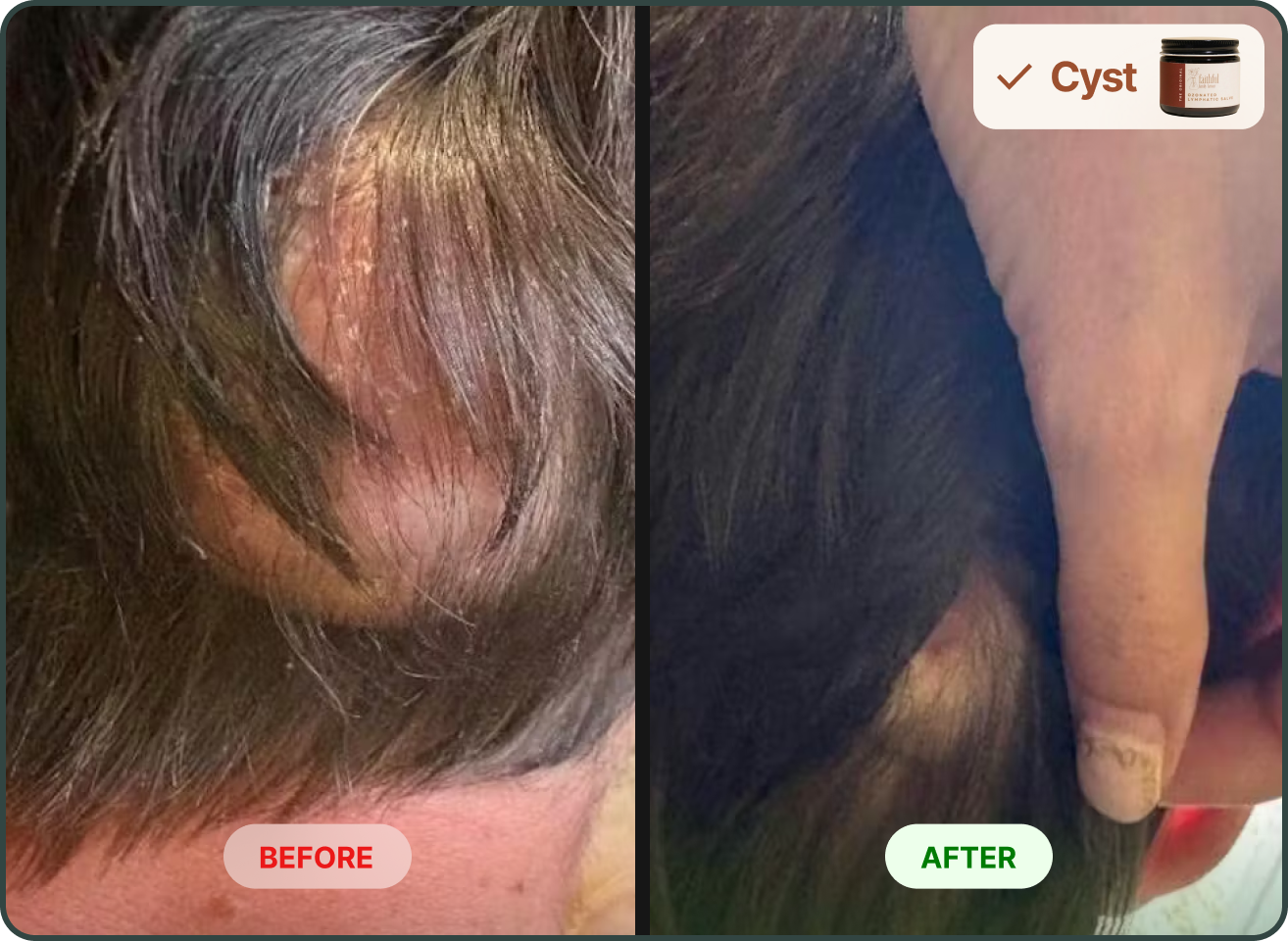 A before and after image showing the reduction in size and inflammation of a cyst on a scalp.
