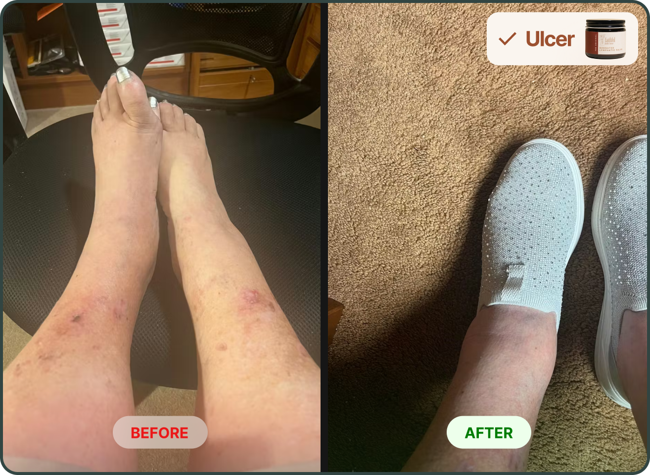 A before and after comparison showing improvement in ulcers on a person's lower legs.