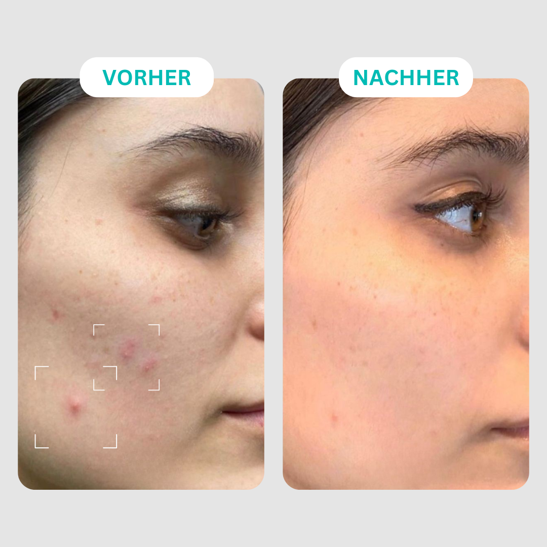 Before and after comparison of facial skin improvement.