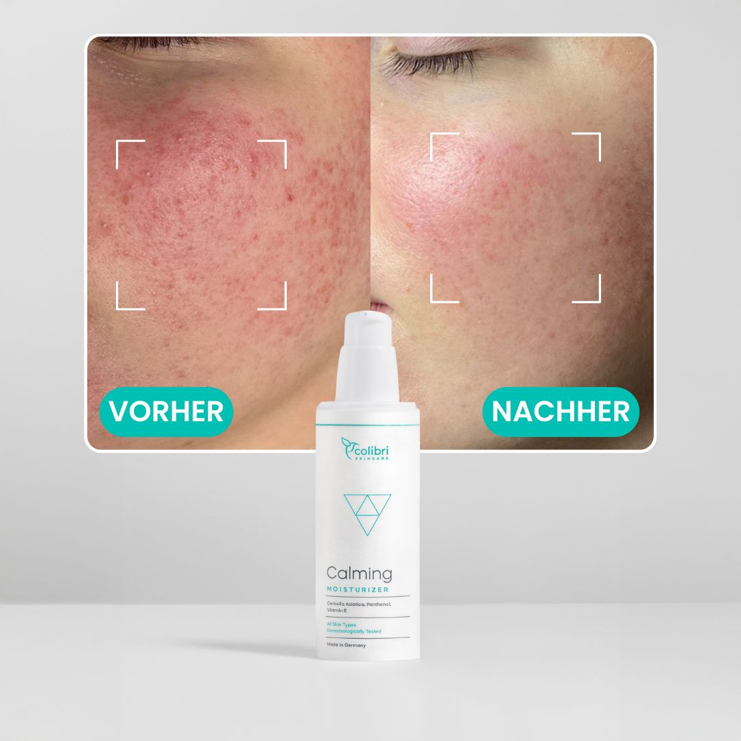 Before and after close-up of cheek redness with a calming moisturizer bottle.